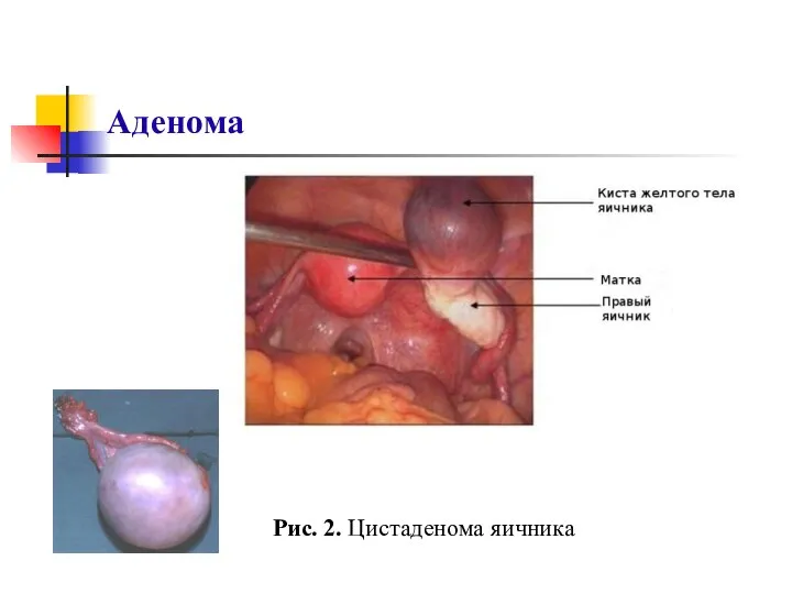 Аденома Рис. 2. Цистаденома яичника