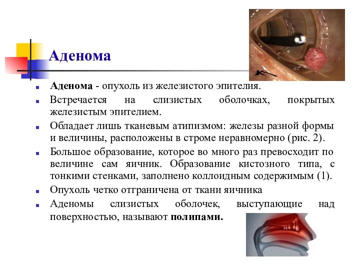 Аденома Аденома - опухоль из железистого эпителия. Встречается на слизистых оболочках,