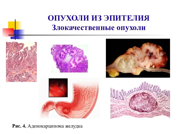 ОПУХОЛИ ИЗ ЭПИТЕЛИЯ Злокачественные опухоли Рис. 4. Аденокарцинома желудка