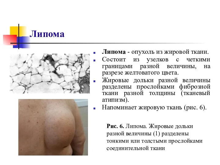 Липома Липома - опухоль из жировой ткани. Состоит из узелков с