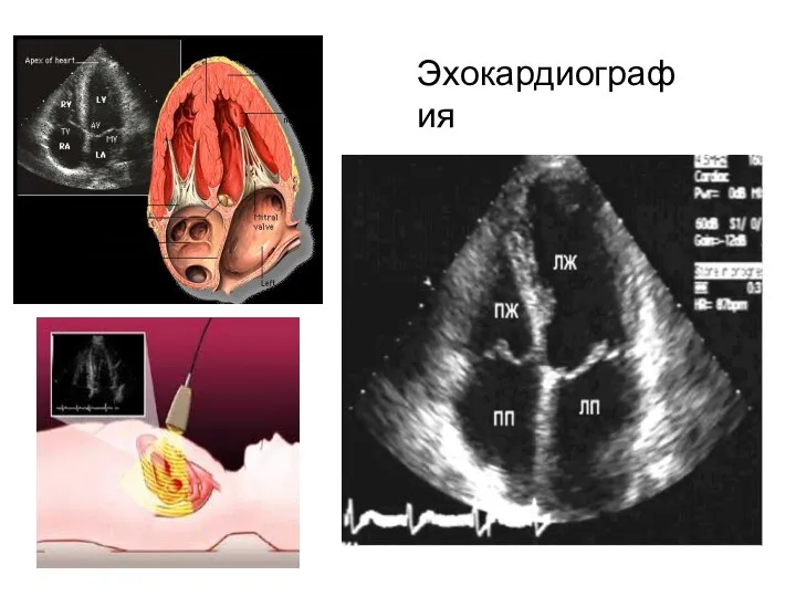 Эхокардиография