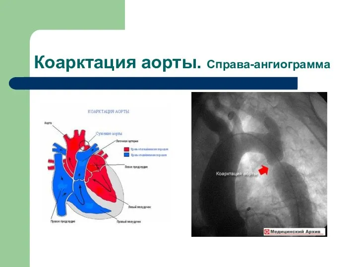 Коарктация аорты. Справа-ангиограмма