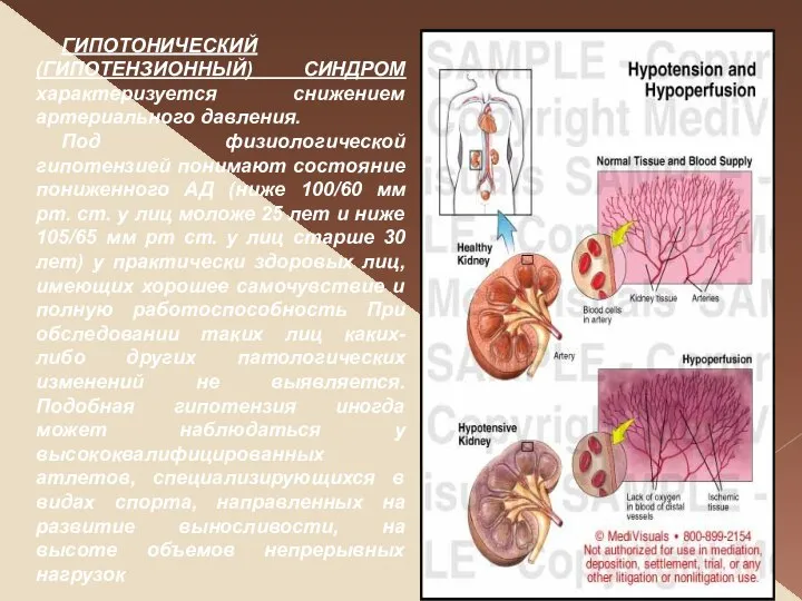 ГИПОТОНИЧЕСКИЙ (ГИПОТЕНЗИОННЫЙ) СИНДРОМ характеризуется снижением артериального давления. Под физиологической гипотензией понимают