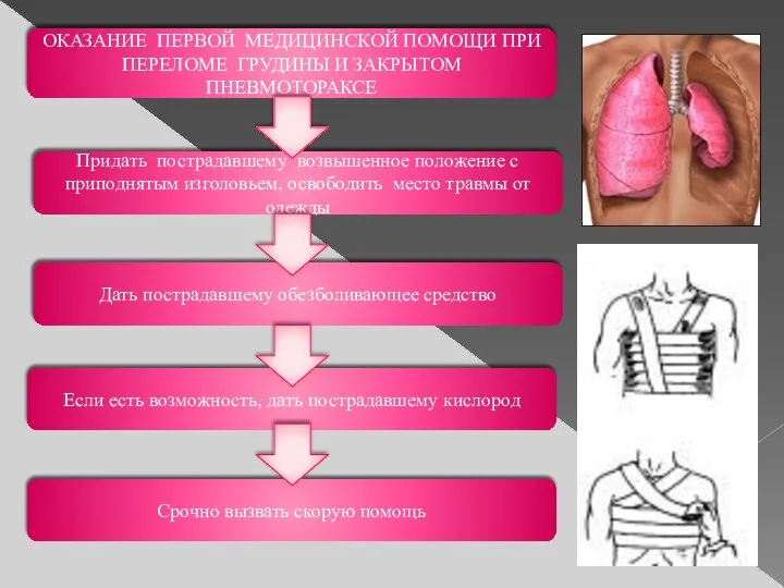 ОКАЗАНИЕ ПЕРВОЙ МЕДИЦИНСКОЙ ПОМОЩИ ПРИ ПЕРЕЛОМЕ ГРУДИНЫ И ЗАКРЫТОМ ПНЕВМОТОРАКСЕ Придать