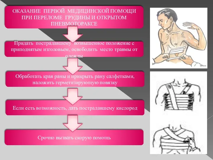 ОКАЗАНИЕ ПЕРВОЙ МЕДИЦИНСКОЙ ПОМОЩИ ПРИ ПЕРЕЛОМЕ ГРУДИНЫ И ОТКРЫТОМ ПНЕВМОТОРАКСЕ Придать