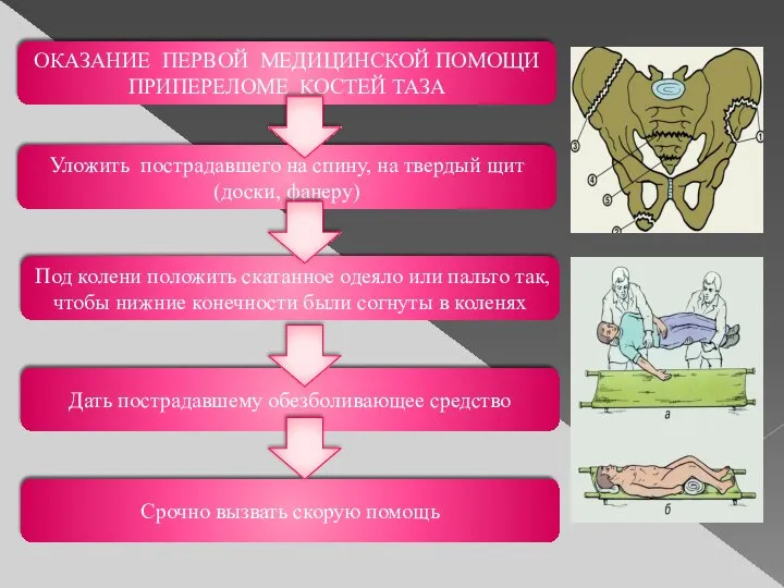 ОКАЗАНИЕ ПЕРВОЙ МЕДИЦИНСКОЙ ПОМОЩИ ПРИПЕРЕЛОМЕ КОСТЕЙ ТАЗА Уложить пострадавшего на спину,