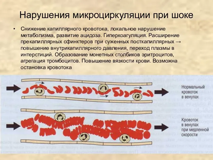 Нарушения микроциркуляции при шоке Снижение капиллярного кровотока, локальное нарушение метаболизма, развитие