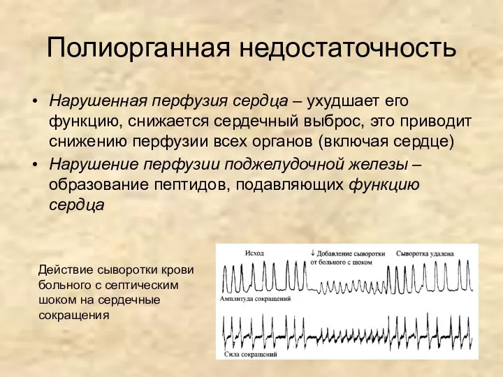 Полиорганная недостаточность Нарушенная перфузия сердца – ухудшает его функцию, снижается сердечный