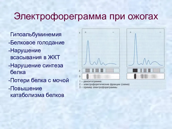 Электрофореграмма при ожогах