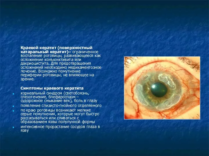 Краевой кератит (поверхностный катаральный кератит)– ограниченное воспаление роговицы, развивающееся как осложнение