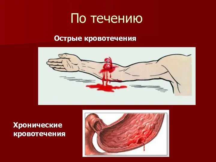 По течению Острые кровотечения Хронические кровотечения