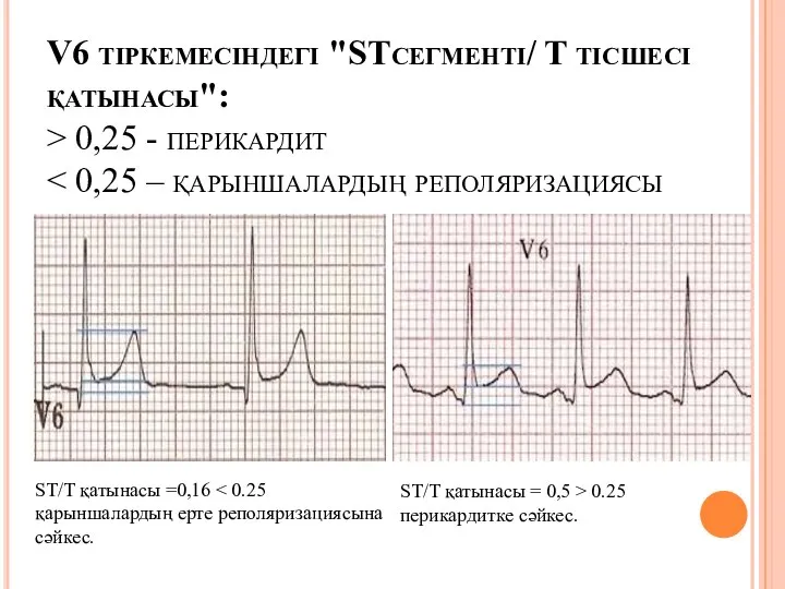 V6 тіркемесіндегі "STсегменті/ T тісшесі қатынасы": > 0,25 - перикардит ST/T