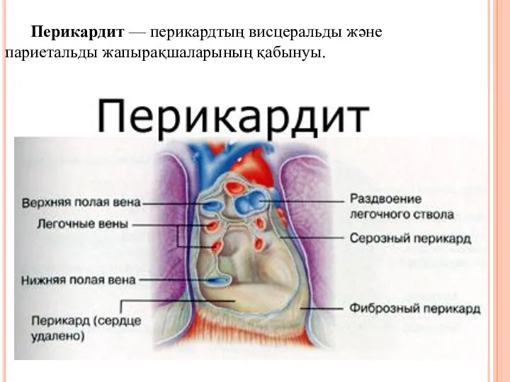 Перикардит — перикардтың висцеральды және париетальды жапырақшаларының қабынуы.