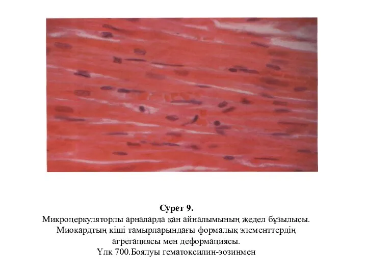 Сурет 9. Микроцеркуляторлы арналарда қан айналымының жедел бұзылысы. Миокардтың кіші тамырларындағы