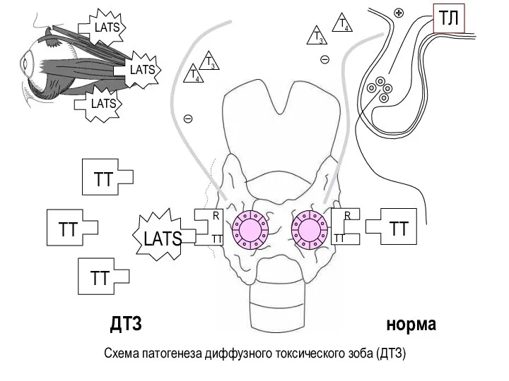 ТЛ ТТ ТТ R Схема патогенеза диффузного токсического зоба (ДТЗ) ТТ R ДТЗ норма