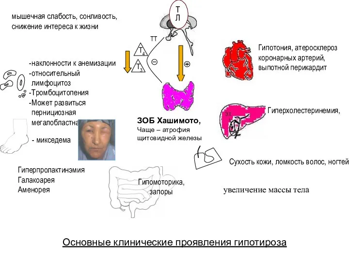 ТЛ ТТ Гипотония, атеросклероз коронарных артерий, выпотной перикардит Гипомоторика, запоры -