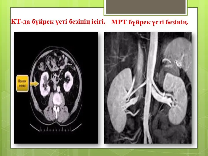 КТ-да бүйрек үсті безінің ісігі. МРТ бүйрек үсті безінің.