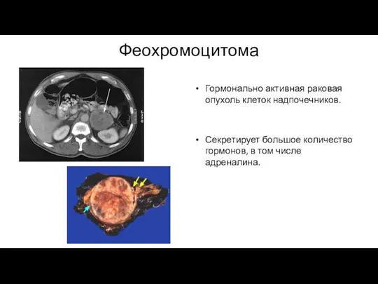 Феохромоцитома Гормонально активная раковая опухоль клеток надпочечников. Секретирует большое количество гормонов, в том числе адреналина.