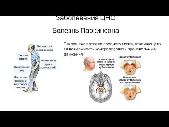 Заболевания ЦНС Болезнь Паркинсона Разрушение отдела среднего мозга, отвечающего за возможность контролировать произвольные движения