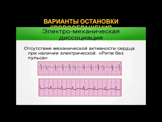 ВАРИАНТЫ ОСТАНОВКИ КРОВООБРАЩЕНИЯ Электромеханическая диссоциация