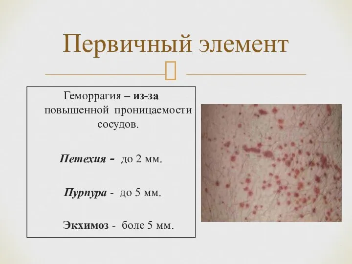 Геморрагия – из-за повышенной проницаемости сосудов. Петехия - до 2 мм.