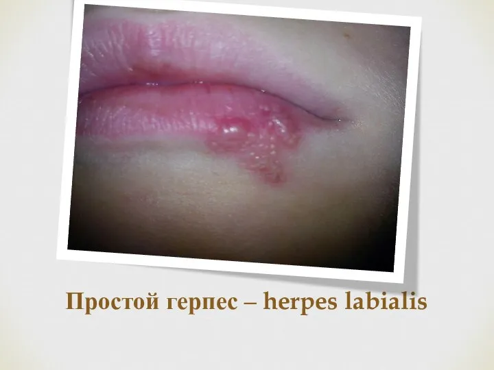 Простой герпес – herpes labialis