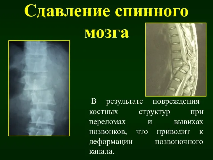 Сдавление спинного мозга В результате повреждения костных структур при переломах и