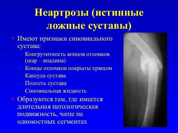 Неартрозы (истинные ложные суставы) Имеют признаки синовиального сустава: Конгруэнтность концов отломков