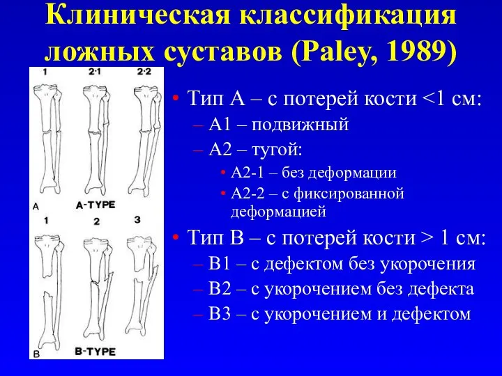 Клиническая классификация ложных суставов (Paley, 1989) Тип А – с потерей