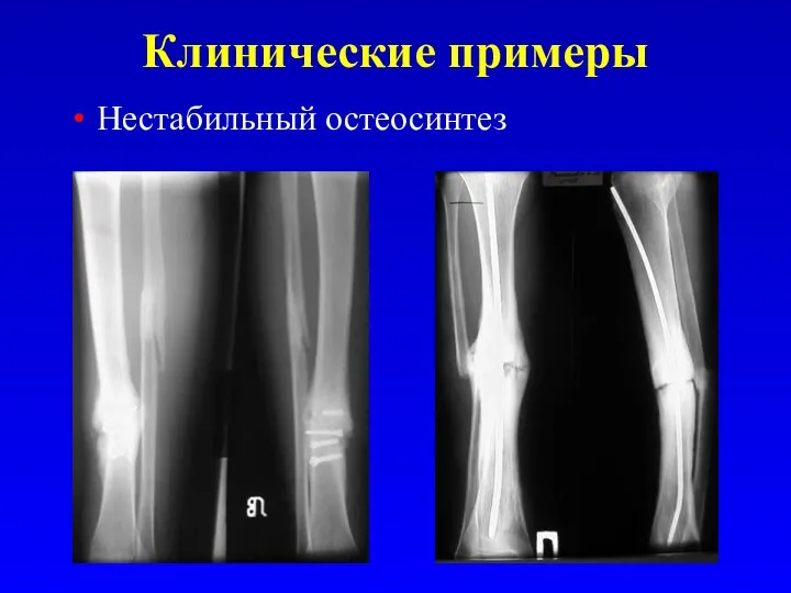 Клинические примеры Нестабильный остеосинтез