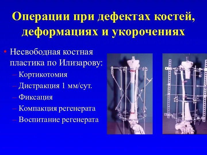 Операции при дефектах костей, деформациях и укорочениях Несвободная костная пластика по