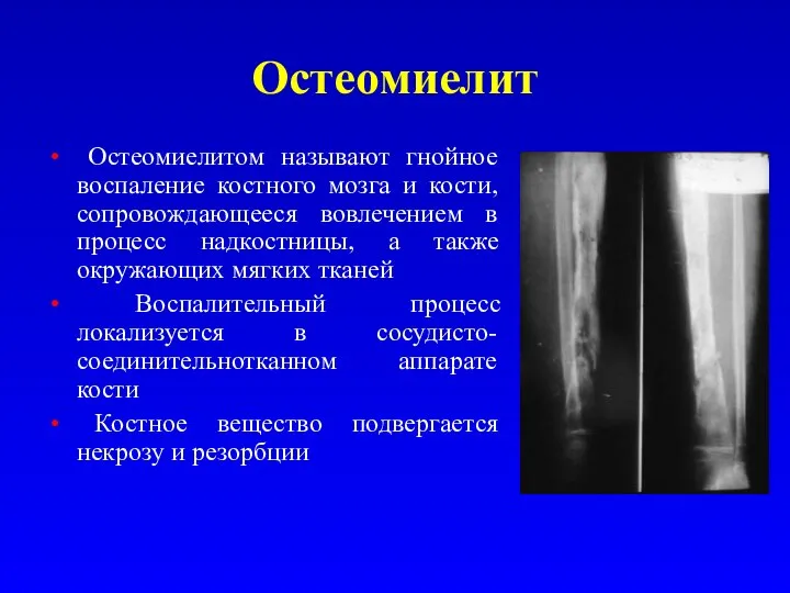 Остеомиелит Остеомиелитом называют гнойное воспаление костного мозга и кости, сопровождающееся вовлечением