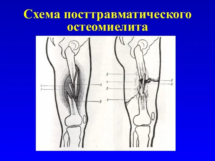 Схема посттравматического остеомиелита