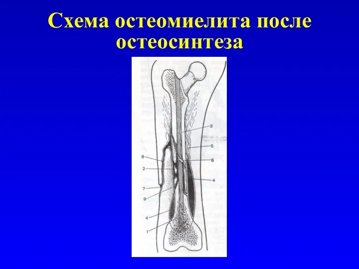 Схема остеомиелита после остеосинтеза