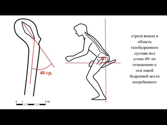 стрела вошла в область тазобедренного сустава под углом 40◦ по отношению