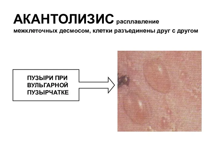 АКАНТОЛИЗИС расплавление межклеточных десмосом, клетки разъединены друг с другом ПУЗЫРИ ПРИ ВУЛЬГАРНОЙ ПУЗЫРЧАТКЕ