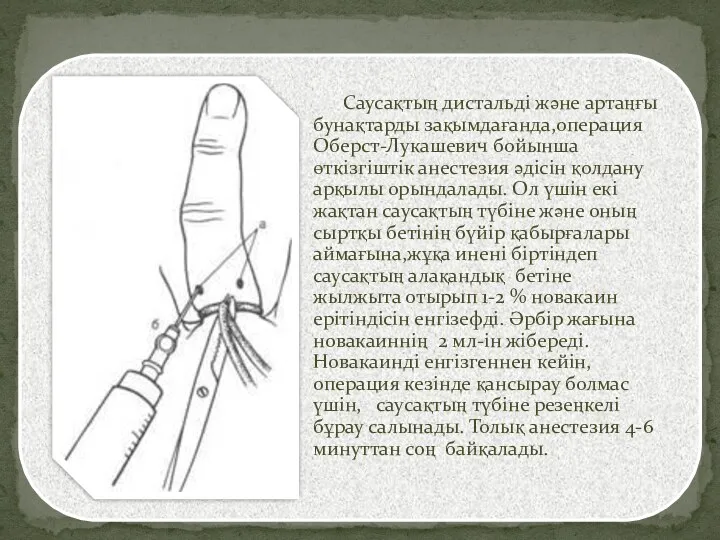 Саусақтың дистальді және артаңғы бунақтарды зақымдағанда,операция Оберст-Лукашевич бойынша өткізгіштік анестезия әдісін