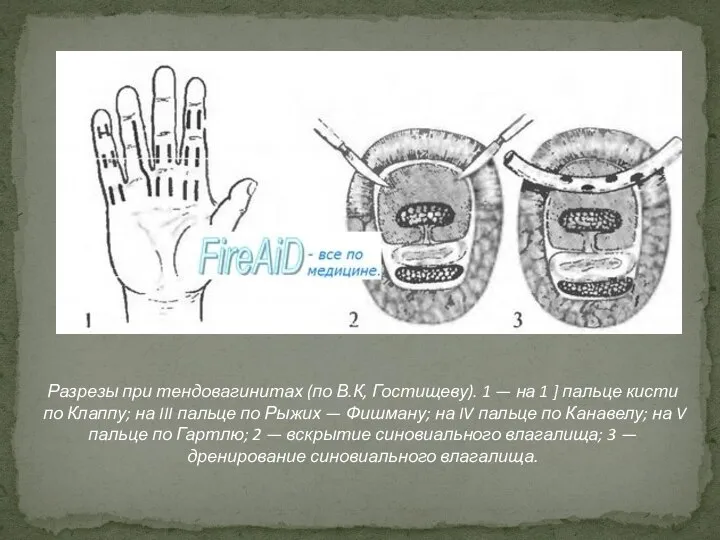 Разрезы при тендовагинитах (по В.К, Гостищеву). 1 — на 1 ]