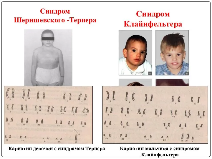 Синдром Шеришевского -Тернера Синдром Клайнфельтера Кариотип девочки с синдромом Тернера Кариотип мальчика с синдромом Клайнфельтера