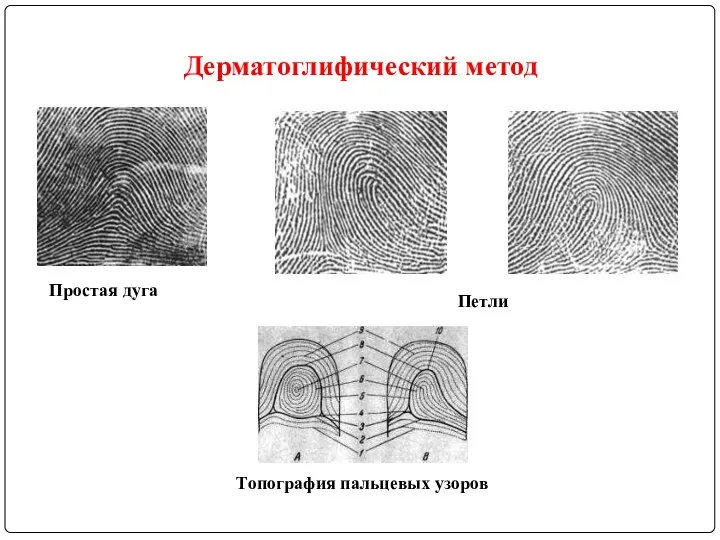 Простая дуга Петли Топография пальцевых узоров Дерматоглифический метод