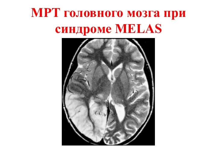 МРТ головного мозга при синдроме MELAS