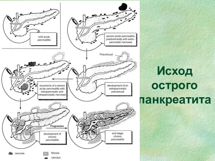 Исход острого панкреатита