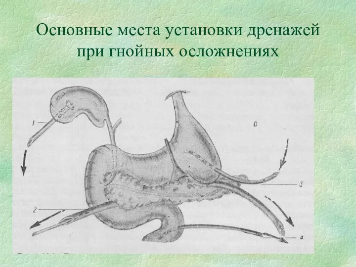 Основные места установки дренажей при гнойных осложнениях