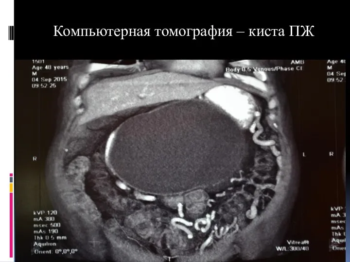 Компьютерная томография – киста ПЖ