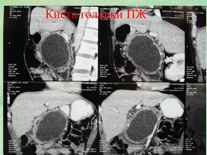 Киста головки ПЖ