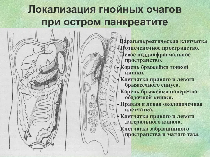 Локализация гнойных очагов при остром панкреатите - Парапанкреатическая клетчатка - Подпеченочное