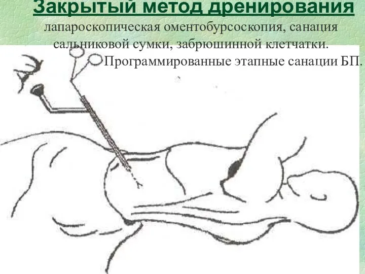 Закрытый метод дренирования лапароскопическая оментобурсоскопия, санация сальниковой сумки, забрюшинной клетчатки. Программированные этапные санации БП.