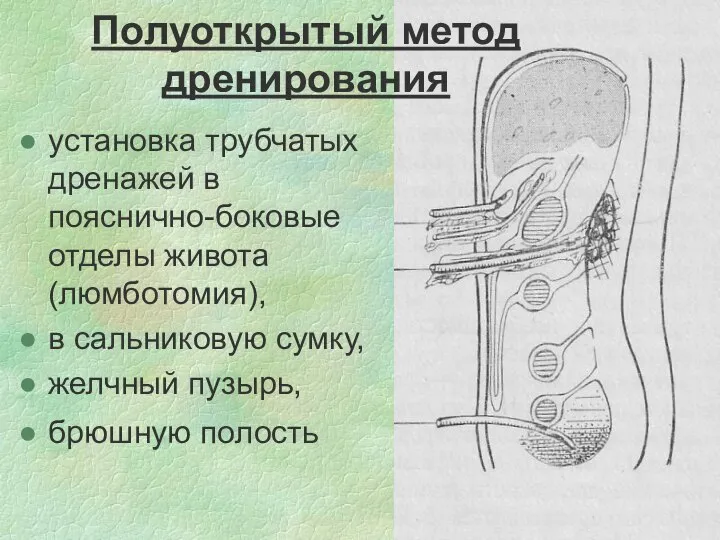 установка трубчатых дренажей в пояснично-боковые отделы живота (люмботомия), в сальниковую сумку,