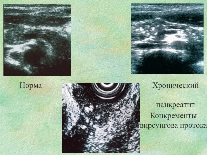 Норма Хронический панкреатит Конкременты вирсунгова протока