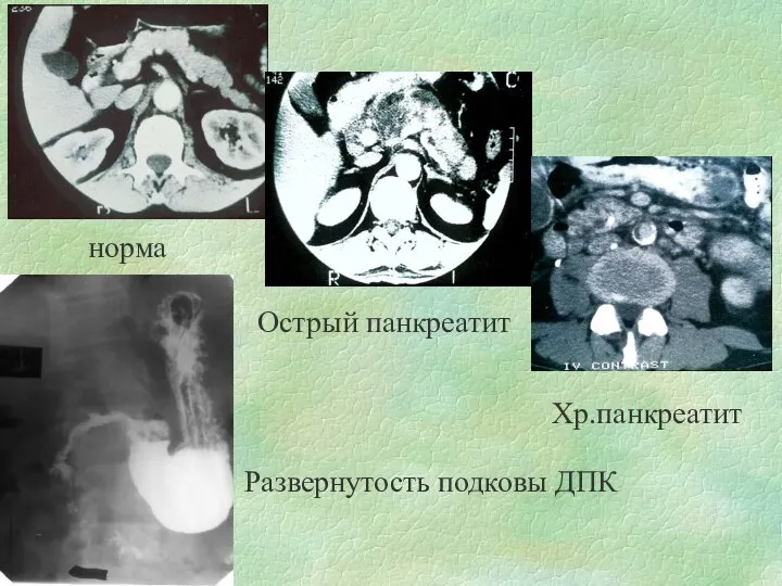 норма Острый панкреатит Хр.панкреатит Развернутость подковы ДПК
